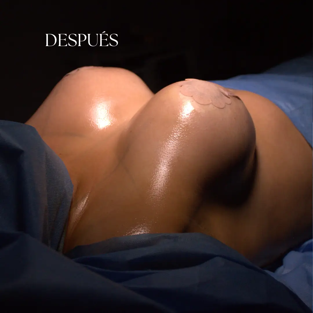 Resultados de Lifting Deep Plane - Foto antes